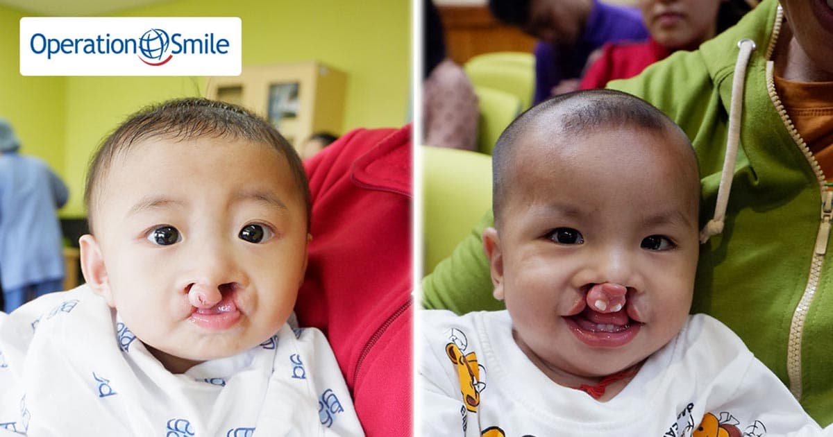 Chung tay gây quỹ tặng 20 nụ cười thay đổi cuộc đời cho các em bé hở môi, hàm ếch
