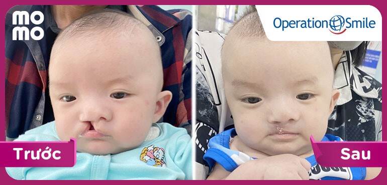 Thêm một em bé được cộng đồng MoMo hỗ trợ phẫu thuật thành công